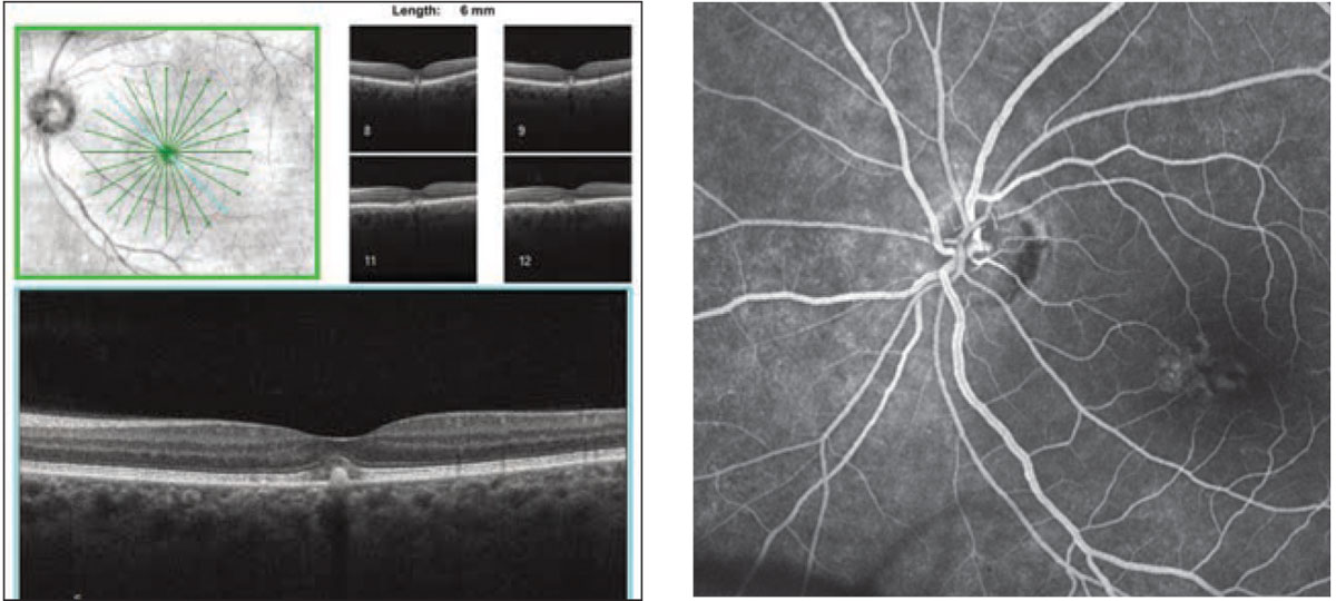 Figs. 2 and 3. How do you interpret this SD-OCT of the left eye (left)? What do the macular changes represent in this late-phase FA of the left eye (right)?