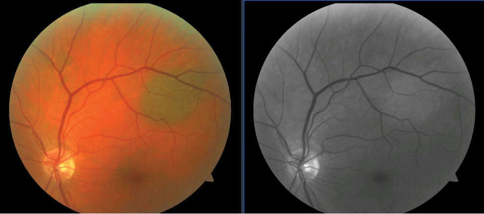 Fig. 1. A choroidal nevus is seen superior-temporal to the optic nerve (left). Choroidal lesions disappear or become much lighter with use of the red-free filter as blood vessels appear black against the uniformly dark background caused by the retinal pigment epithelium (right).