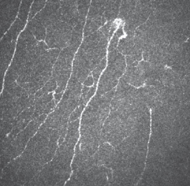 In vivo confocal microscopy can identify swollen distal nerves. 