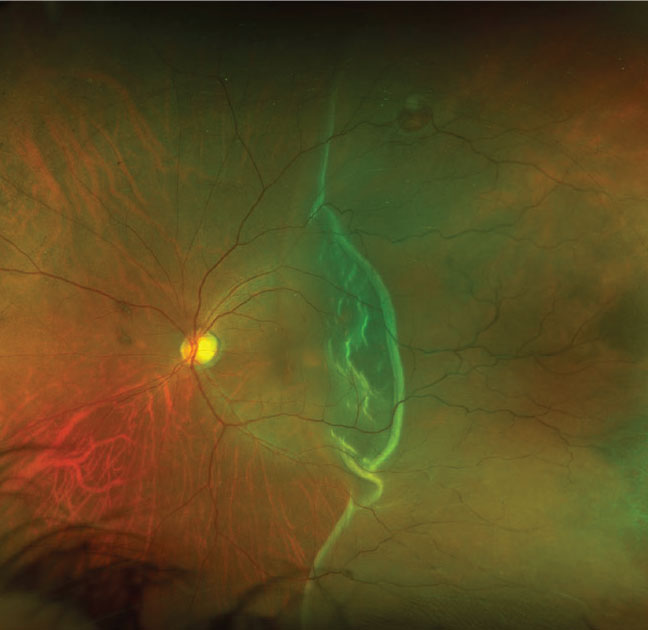 Fig. 1. This is the widefield fundus photo of the left eye of our patient. What does this finding represent?