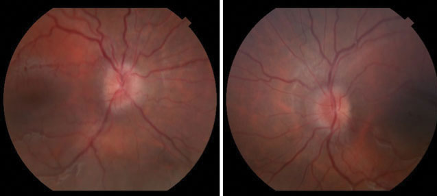 Fig. 1. Fundus photographs at the initial visit revealed mild bilateral optic nerve edema.