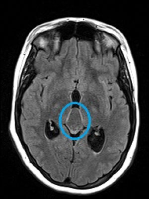 Fig. 4. MRI revealed a large pineal cyst (blue circles).