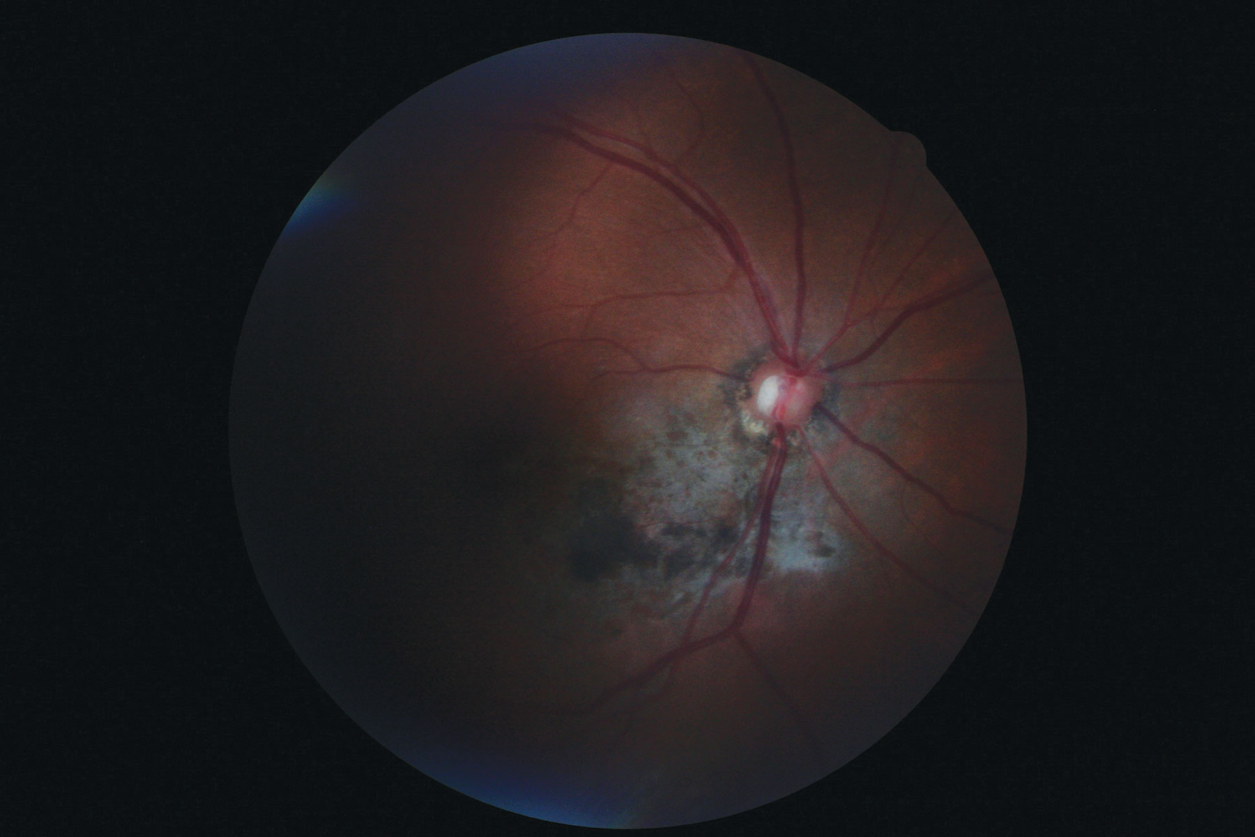 Dilated fundus exam of the patient revealed the findings shown here. In what way might they relate to the incident (an auto accident) she described upon presentation?