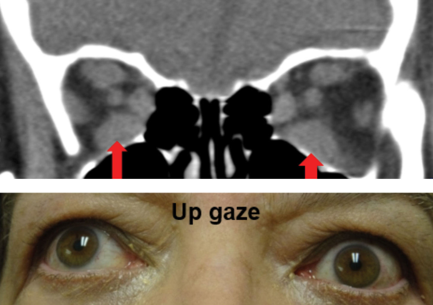 Enlargement of the bilateral inferior recti muscles OS>OD as noted with the red arrows on the CT scan above resulted in a bilateral supraduction limitations. Note the Purkinje image is higher on the cornea of the left eye, which is the eye with the greater supraduction limitation.