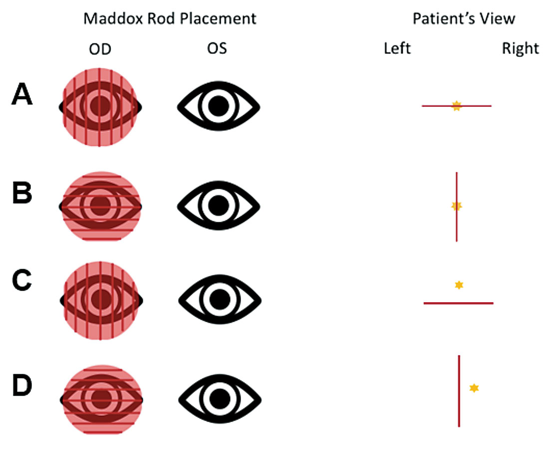 Maddox rod testing for horizontal and vertical misalignments. The red line is viewed with the right eye, and the yellow star represents the light source viewed by the left eye. A is the patient view if no vertical deviation. B is the view if no horizontal deviation. C is the view of a left hyper deviation. D is the view of an eso deviation.