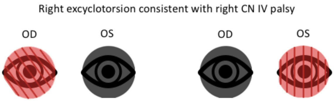 Double Maddox rod testing showing excyclotorsion of the right eye and no torsion when placed over the left eye, consistent with a right CN IV palsy.