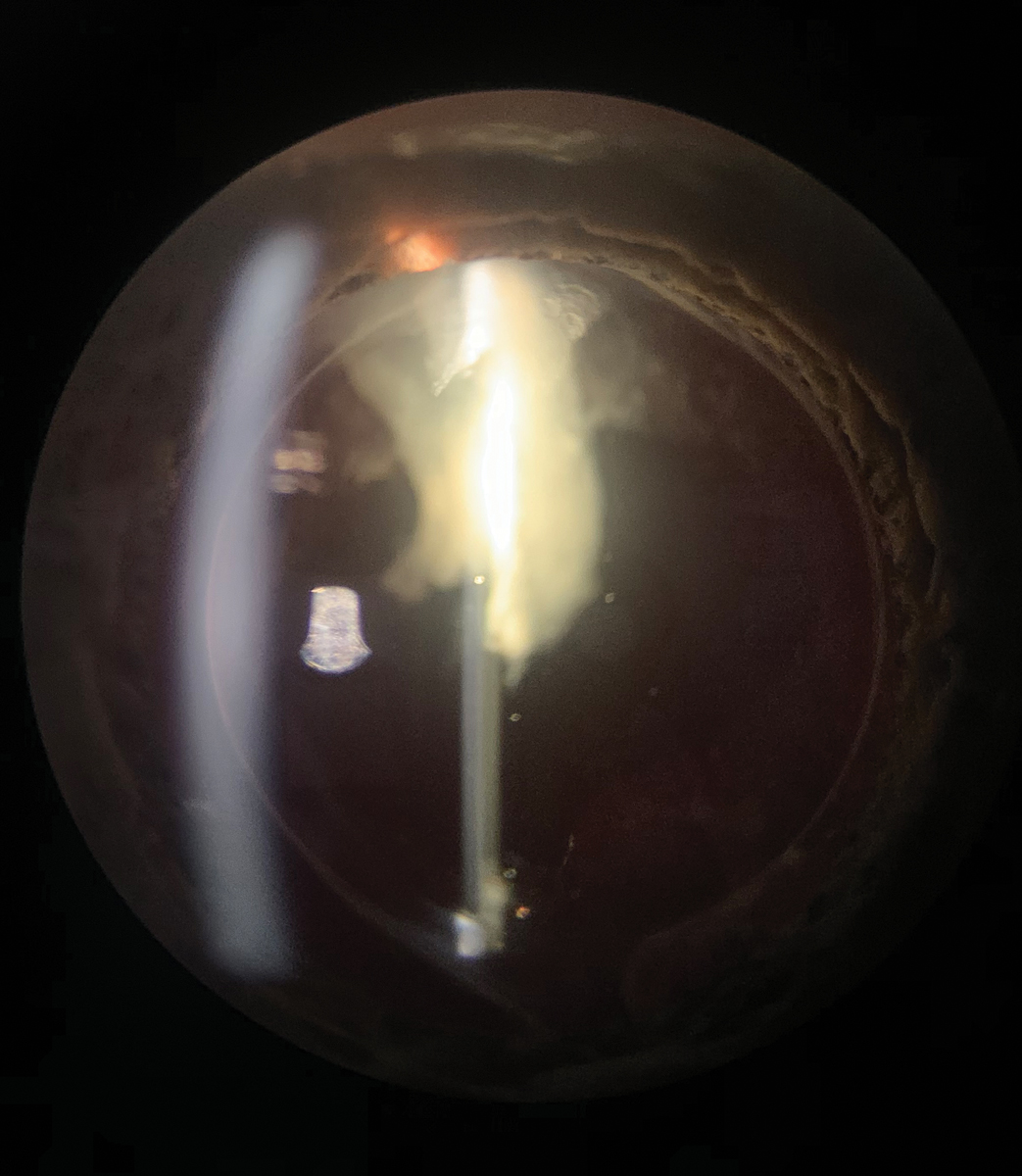 This large retained lens fragment protruding into this patient’s visual axis caused phacoanaphylaxis.