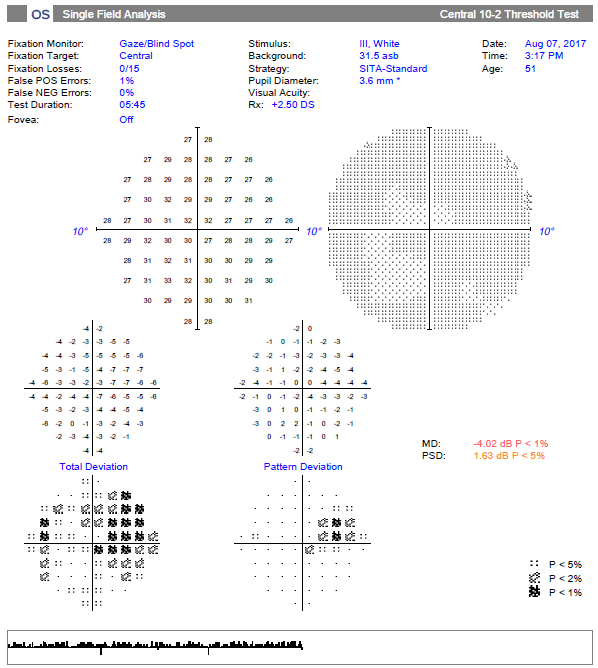 The 10-2 test grid of the same patient reveals a much more substantial superior nasal defect that correlates to the inferotemporal macular damage.