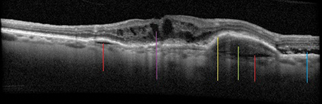 Fig. 9. Exudative macular degeneration demonstrating sub-RPE fluid (red lines), sub-RPE hemorrhage (green line) with exudative PED (yellow line), SRF (blue line) and intraretinal fluid (purple line).