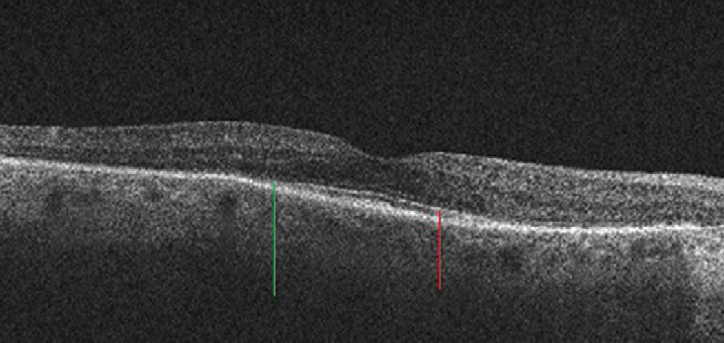 Fig. 11. In this rod-cone dystrophy, the outer retina (specifically ONL) has collapsed where the ellipsoid zone (red line) ends (green line).