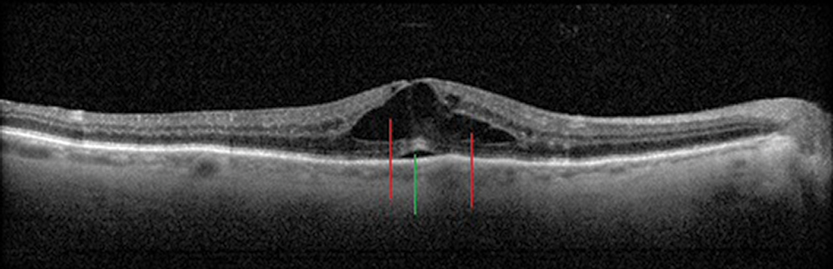 Fig. 12. Cystic intraretinal spaces (red lines) and a focal subfoveal neurosensory retinal detachment (green line) in Irvine-Gass/post-op CME.