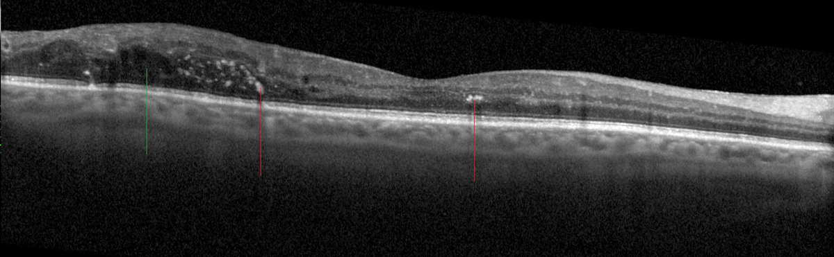 Fig. 13. Hyperreflective foci (red lines) within the retina corresponding to exudates in a patient with diabetic retinopathy and non-central macular edema/IRF (green line).