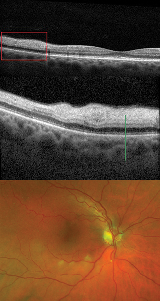 Fig. 16a and b. A broad (upper) and more magnified (lower) scan of NFL edema (green line) in an acute branch retinal artery occlusion. Clinical photo of a branch retinal artery occlusion with an intra-arterial embolus inferior to the disc, segmentation of blood flow downstream and cotton-wool spots in the posterior inferior-temporal arcade (bottom).