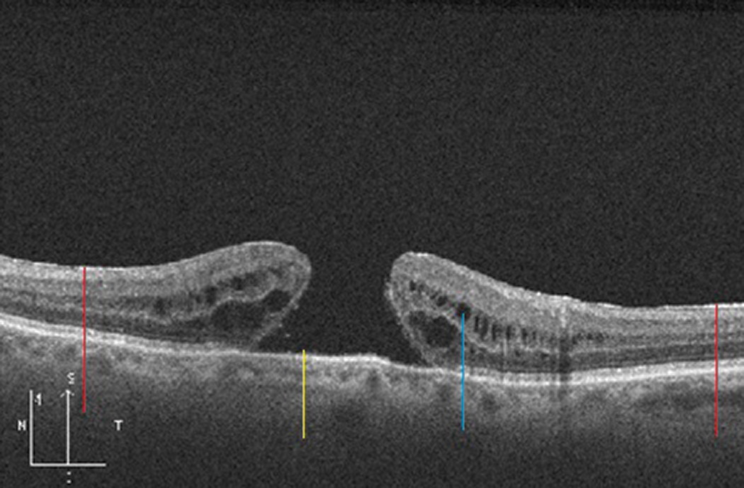 Fig. 17. A full-thickness macular hole (yellow line) with adjacent intraretinal cystic spaces (blue line) in a patient with epiretinal membrane (red lines).