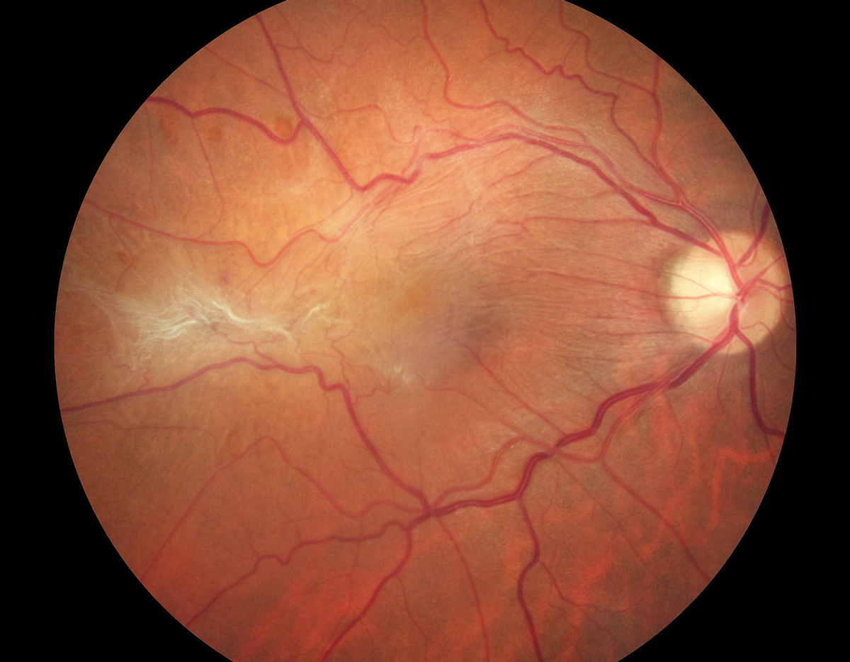 Patients with an epiretinal membrane may not do as well with some types of premium IOL. The comanaging OD needs to have pre-op ocular health assessment and the anticipation of visual outcomes in their skill set. Doing so will elevate the relationship from simple referral to true collaboration.