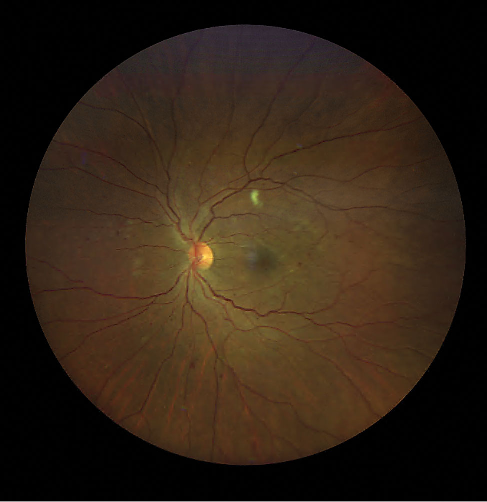 Diabetic retinopathy and a CWS along the superior temporal RNFL arcade.