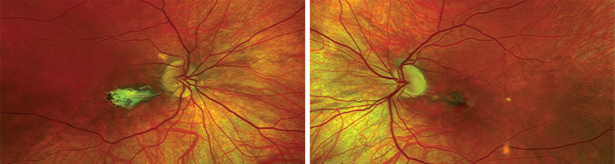 This is the widefield fundus photo of the right (at left) and left eyes of our patient. What does the change in the macula represent?