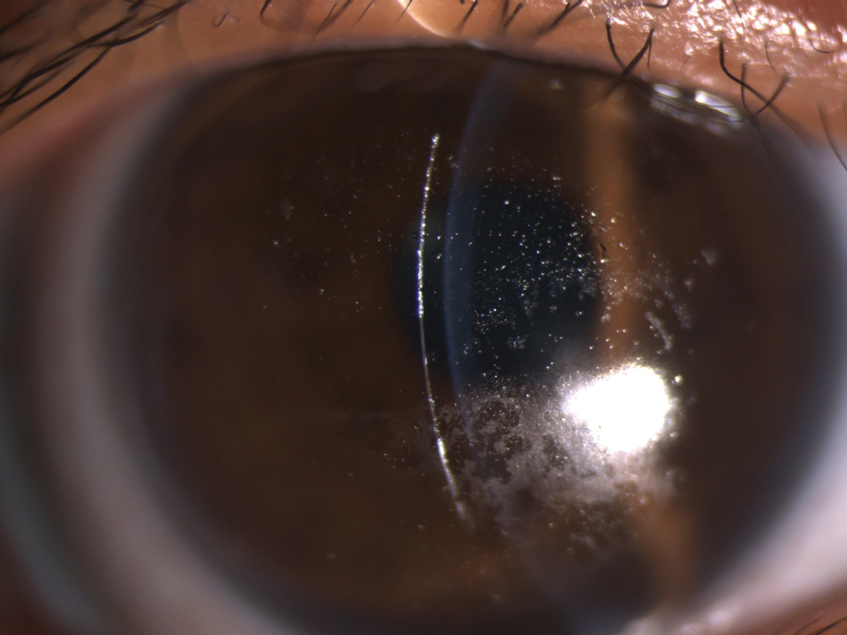 A Hydra-PEG coating would benefit this patient with heavy deposits on a scleral lens.
