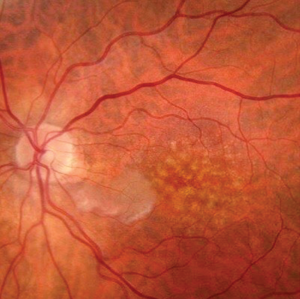 Fundus photography of the retinal whitening corresponds with the cilioretinal artery.