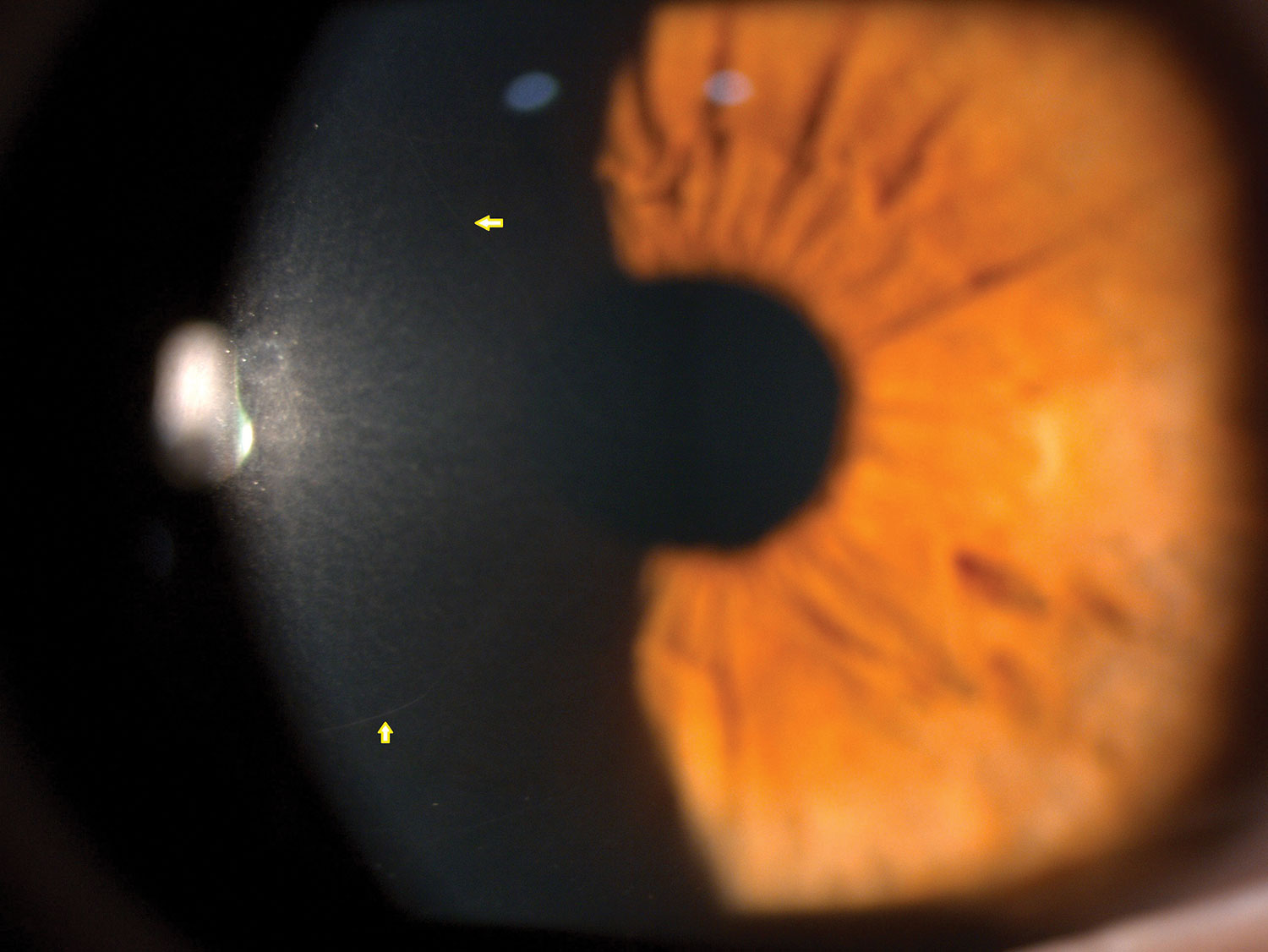 Yellow arrows mark normal corneal nerves in vivo under the slit lamp using specular reflection.