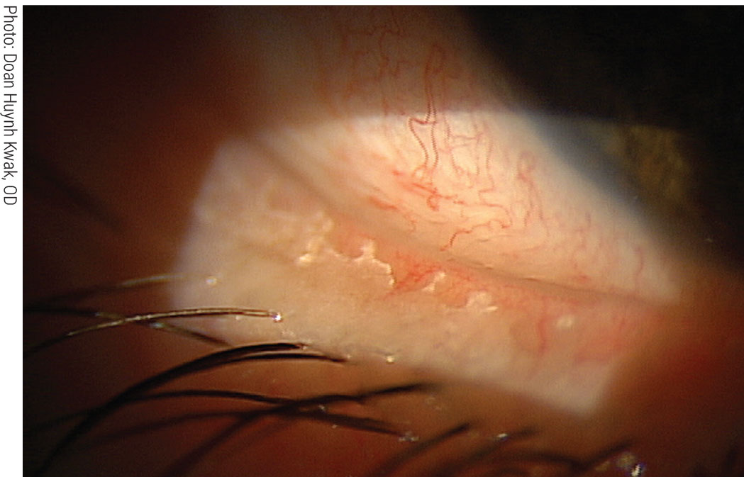 Removing biofilm from the lid margin via BlephEx reduces the risk of blepharitis and dry eye.