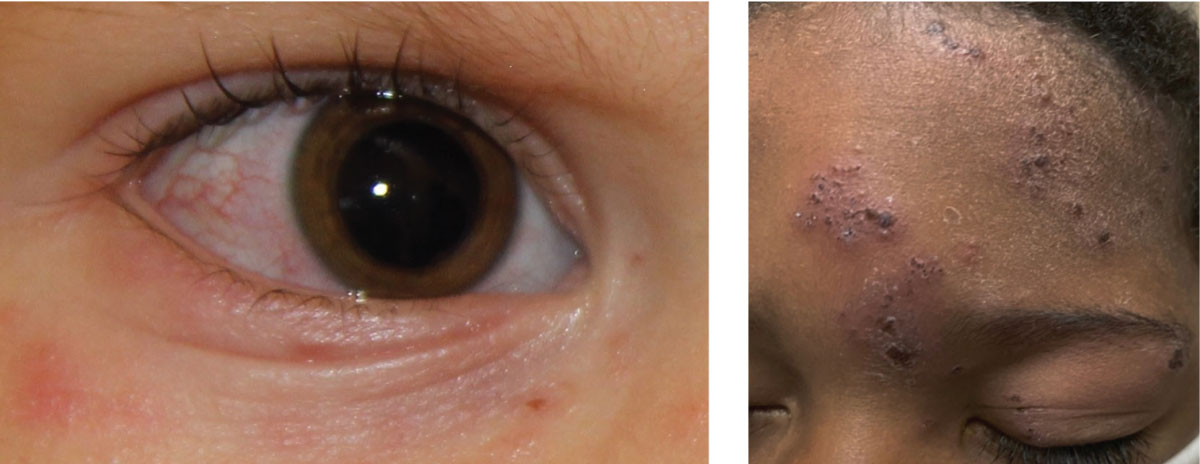 Fig. 1. At left, ocular involvement of herpes zoster with associated rash of the ocular adnexa and surrounding skin; above, classic presentation of herpes zoster.