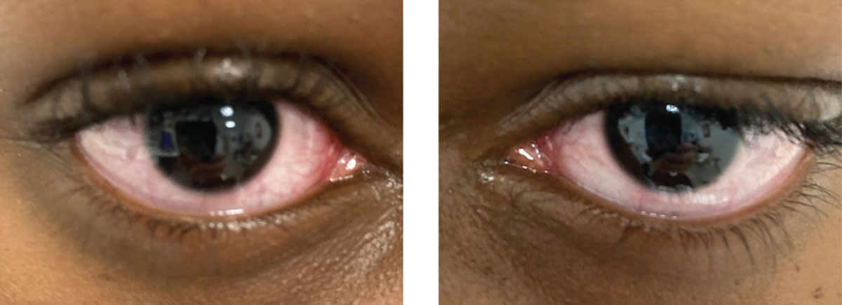 Fig. 3. Same patient, right and left eyes, respectively. Typical presentation of acute-onset red eyes in a school-aged child.