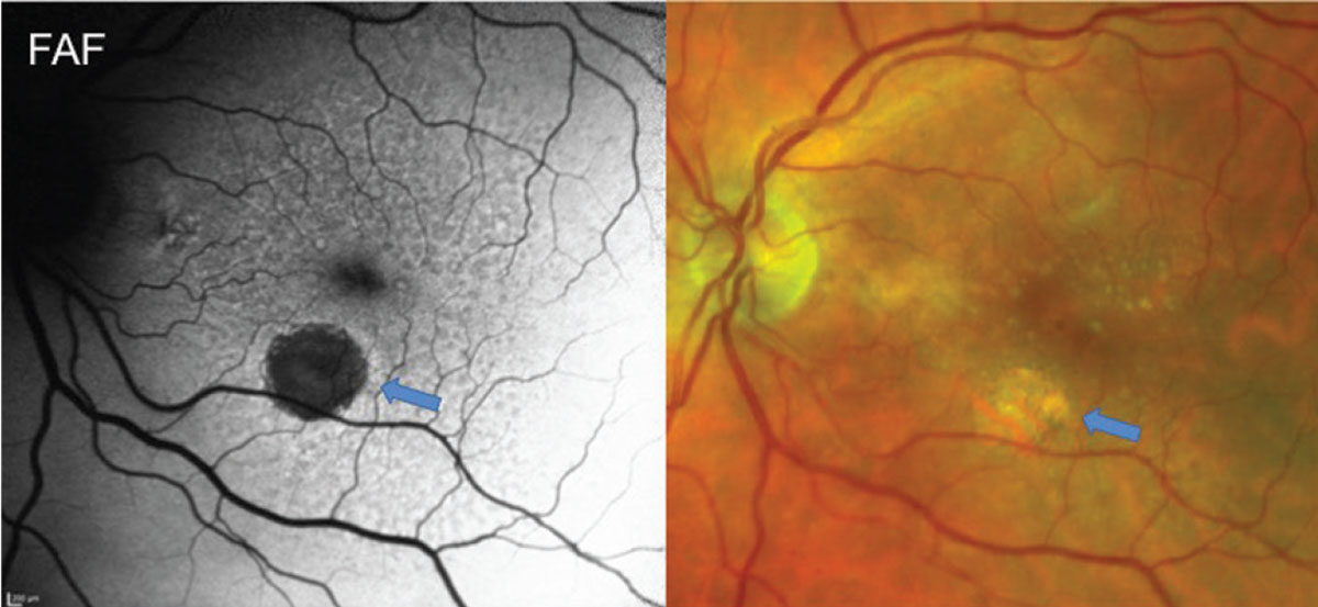 Fig. 2. Fundus autofluorescence and fundus photo of a patient with reticular pseudodrusen and GA. FAF highlights a hypo-autofluorescent region of GA (blue arrows) and shows diffuse RPE alterations from RPD. FAF in patients with RPD often shows more diffuse disease than can be seen clinically with a reticular pattern of circular areas of hypo-autofluorescence often with a hyper-autofluorescent center.