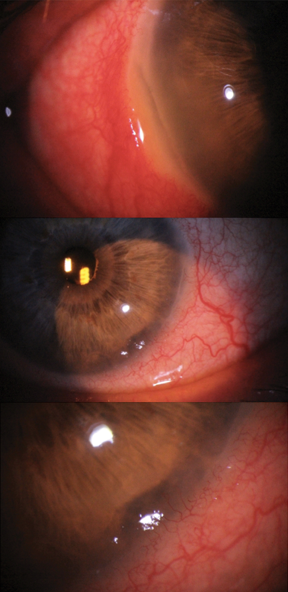 Bilateral Mooren’s ulcer in a 72-year-old white male. The right eye shows limbal melt from 7 to 9 o’clock, while the left eye shows limbal melt from 4 to 5 o’clock. Although scleritis was present in the right eye, this patient tested negative for collagen vascular disease. Due to the bilateral nature and absence of rheumatologic disease, Mooren’s was the working diagnosis rather than peripheral ulcerative keratitis, although both were differentials.