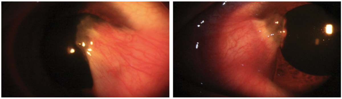 Bilateral thick pterygia in a 33-year-old Hispanic male. Pterygium excision with a conjunctival allograft was recommended in the right eye secondary to the degree of encroachment on the line of sight and significant irregular astigmatism induced by the ptergium.