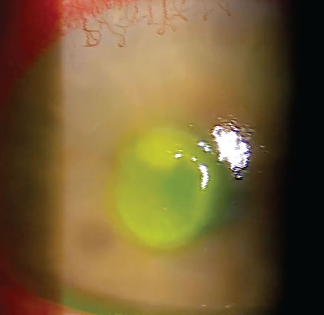 Central corneal ulcer secondary to contact lens abuse.