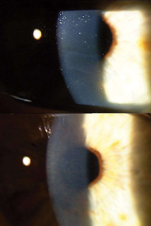 An EBMD patient before (top) and after (bottom) epithelial debridement and amniotic membrane application.