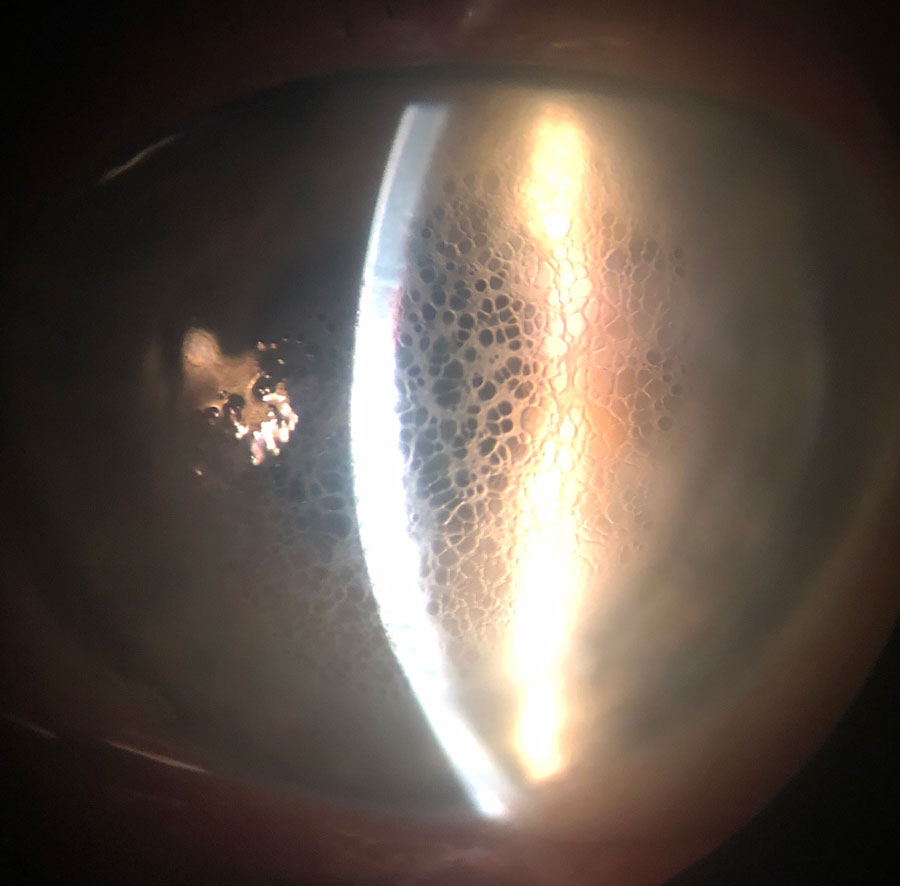 Diffuse honeycomb corneal edema in a post-DSAEK eye. This patient is taking Rhopressa once daily.