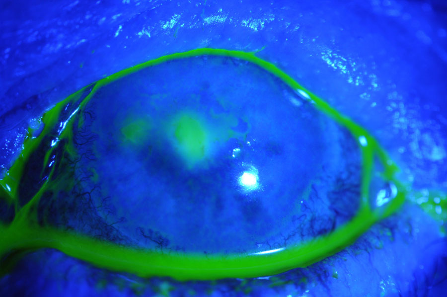 This 56-year-old female had a persistent epithelial defect secondary to trichiasis (caused by squamous cell carcinoma lid surgery). She wore a bandage contact lens for pain and developed an ulcer.