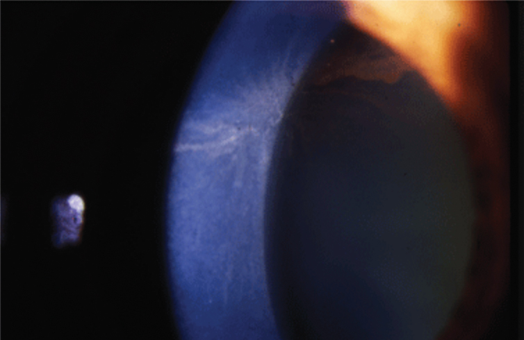 Fig. 1. Amiodarone causes corneal whorl keratopathy, or corneal verticillata, visible at the level of the basal epithelium.