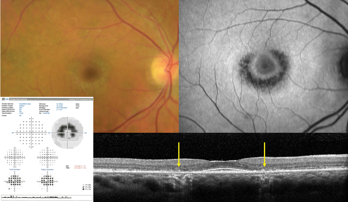 Fig. 4. Classic advanced hydroxychloroquine-induced toxic maculopathy showing parafoveal RPE/outer retinal loss (yellow arrows on OCT), hypoAF on FAF imaging and corresponding paracentral visual field defects.
