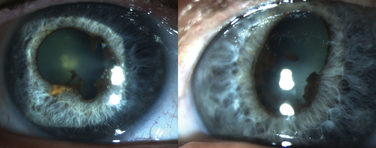 Fig. 8. Findings due to chronic anterior uveitis associated with Keytruda use.