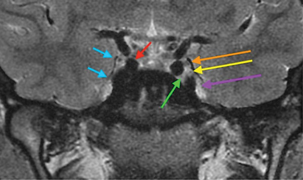MRI imaging of the brain through the cavernous sinus shows the lateral border of the right cavernous sinus (blue), cavernous segment of the right ICA (red), left CN III (orange), left CN IV (yellow) and left CN VI (green). The left CN V-1 and left CN V-2 are not well resolved (purple).