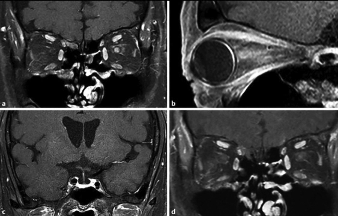 The appearance of optic neuritis on MRI. Optometrists should be comfortable knowing when and why to order neuroimaging work.