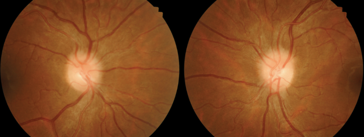 Idiopathic intracranial hypertension is fairly commonly diagnosed by optometrists—and it’s incumbent on them to coordinate care, says Dr. Messner.