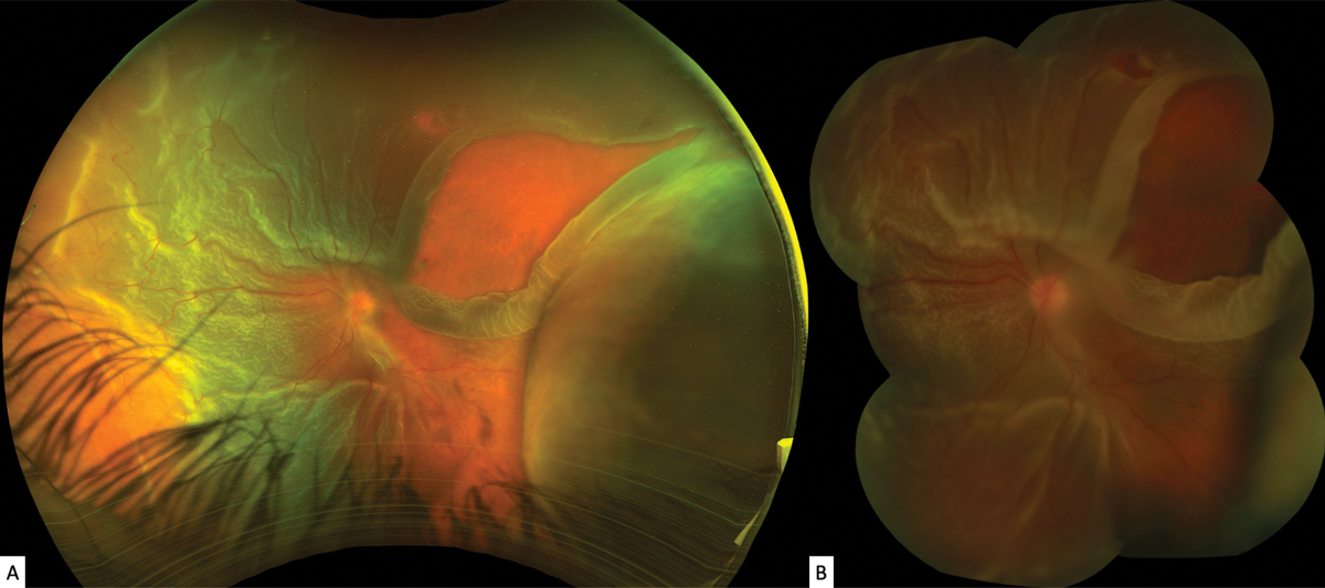 Fig. 1.Optos ultra-widefield (A) and Topcon (B) montage fundus images of the left eye.