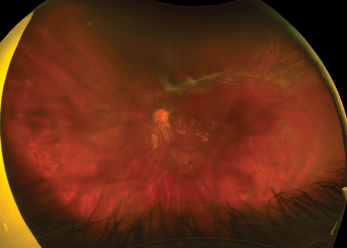 Fig. 2. Ultra-widefield fundus image of the left eye at post-op month two.