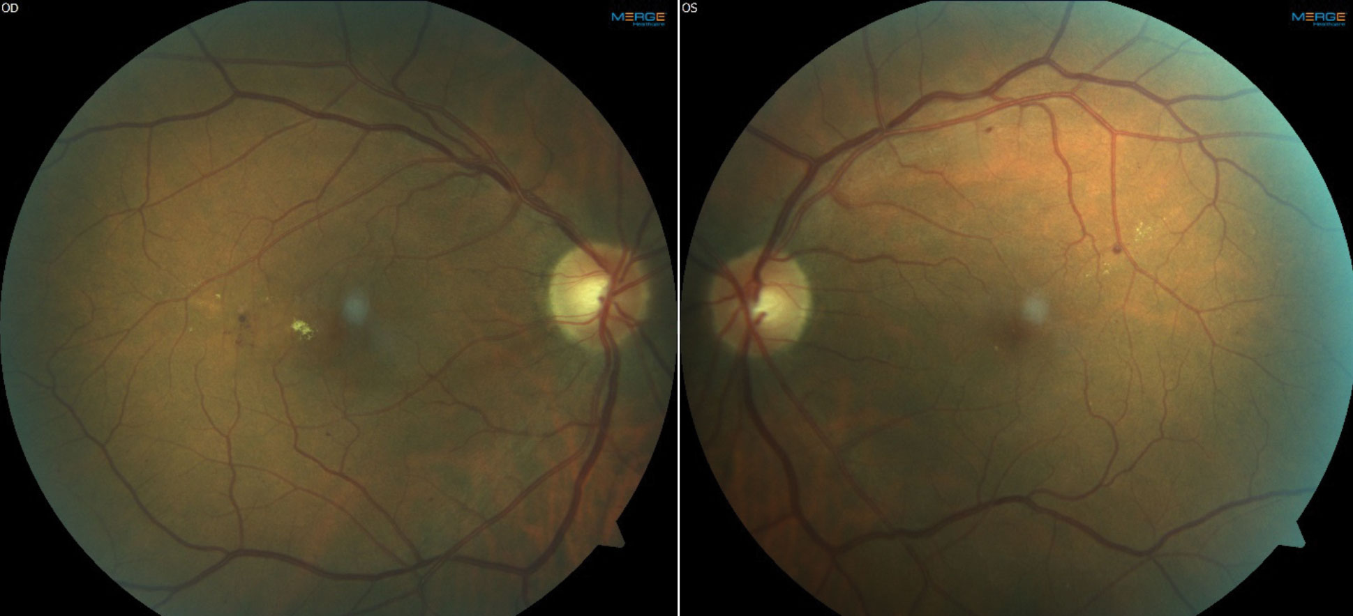 Fundus images and OCT of a patient with moderate NPDR OU and CI-DME OD. The patient’s best corrected acuities were 20/25 OD and 20/20 OS. The comanaging retina specialist elected to monitor the CI-DME OD based on the findings of DRCR Protocol V.
