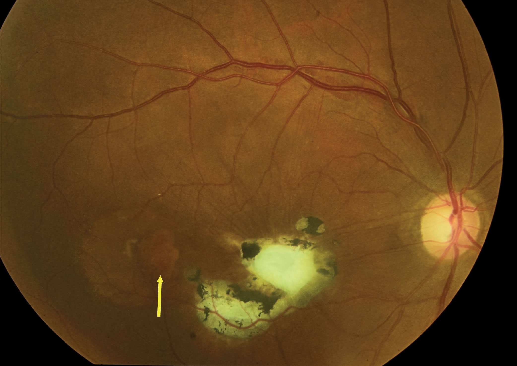 Fundus photo of the right eye. What might that central fibrotic lesion represent?