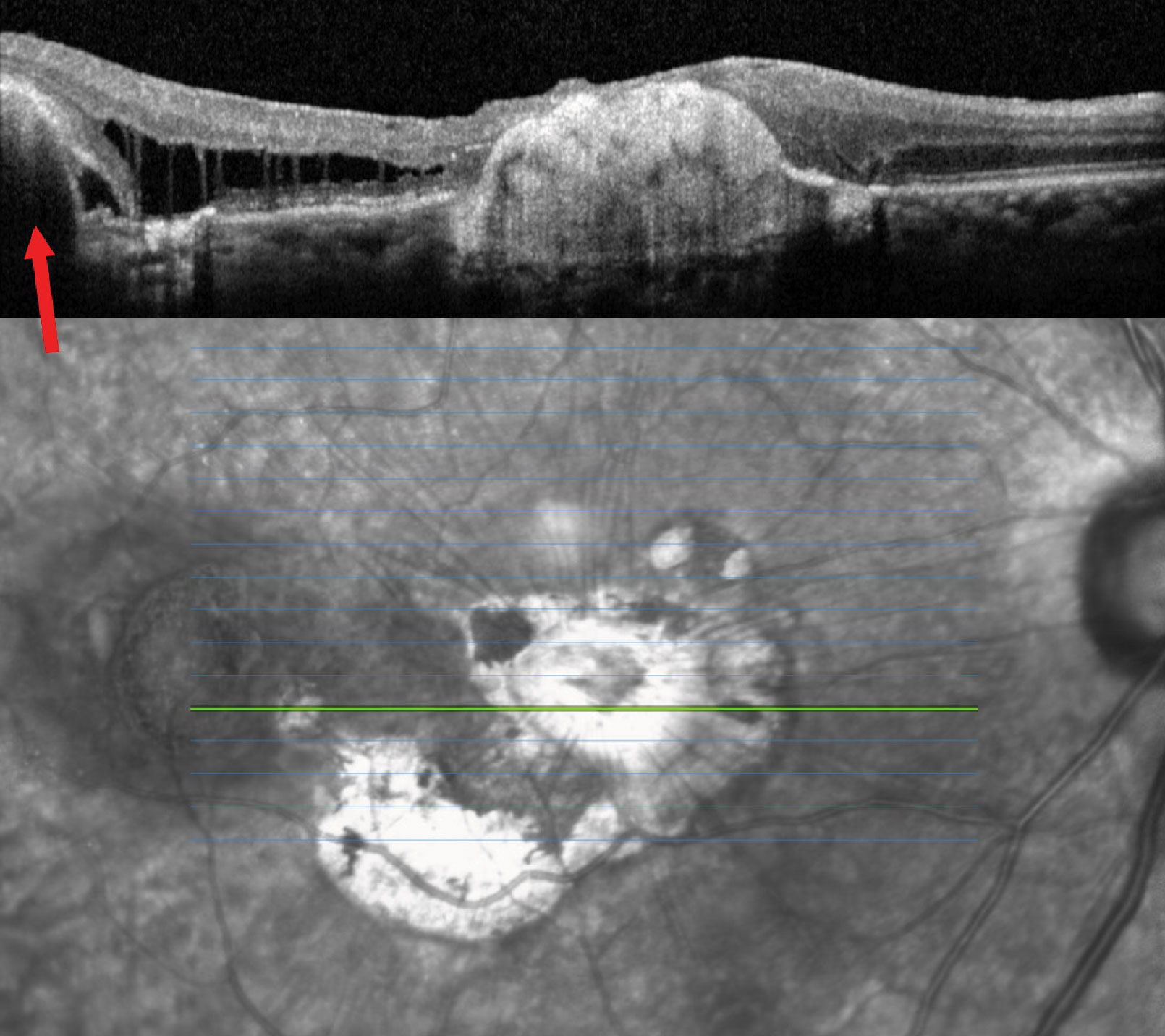 OCT of the right eye. What could the area of RPE elevation possibly correspond to?