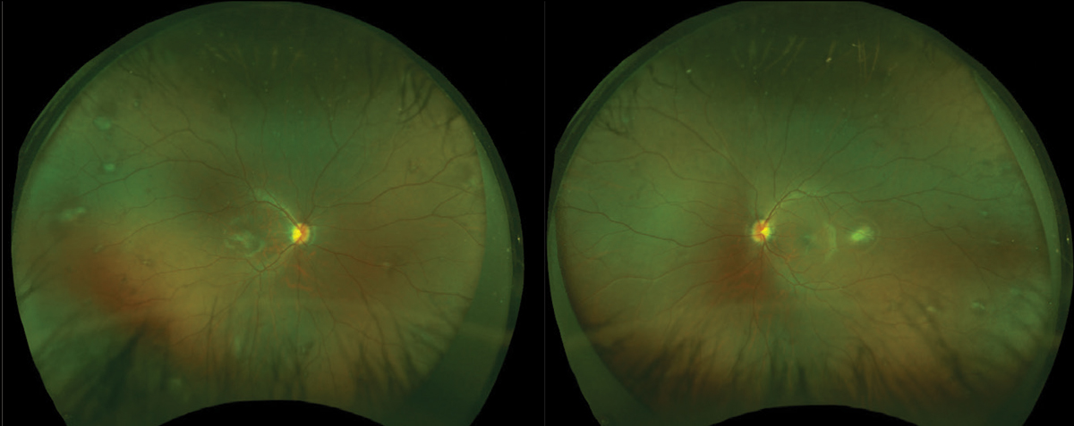 Fundus images of the right and left eyes reveal that CHRRPE lesions often appear elevated and pigmented (usually grey, white or brown, but may be orange, yellow or green).