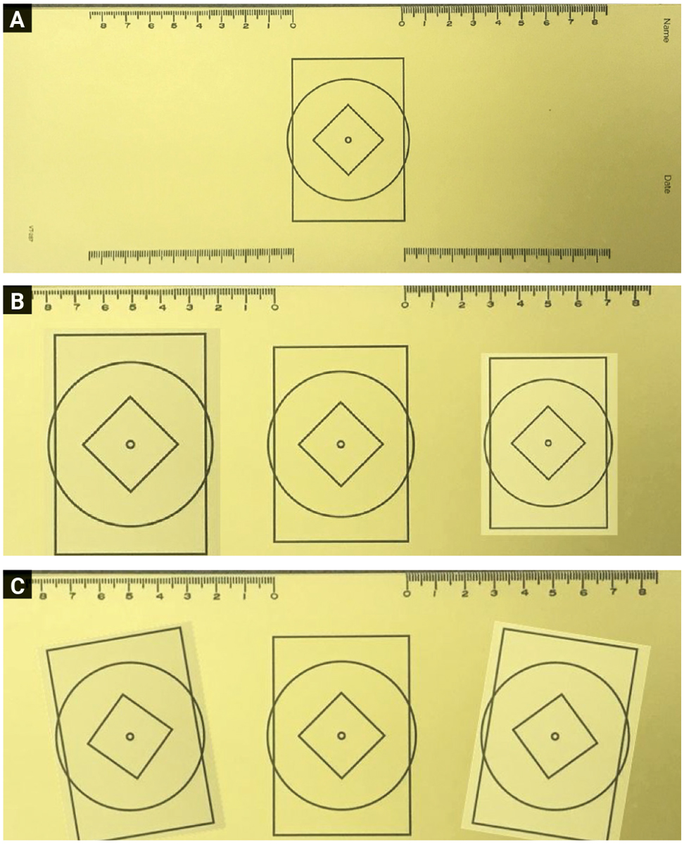Fig. 3. On top (A) is the blank form used to perform the tracings. The middle image (B) shows a roughly 10% size difference. Note that each side must show a similar amount of size difference, but in the opposite direction. On the bottom (C) is a clinically significant cyclorotation.