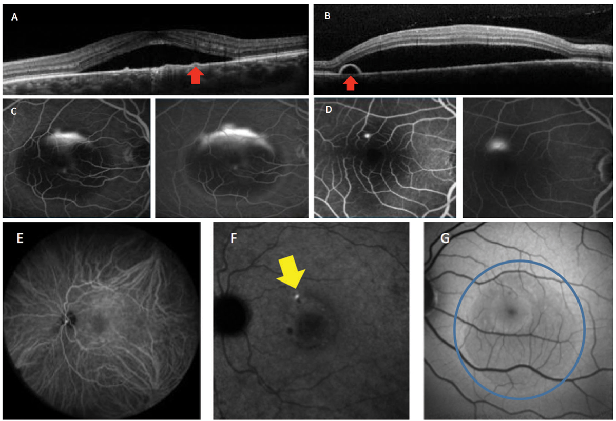 Fig. 2. This patient has acute CSCR. OCT imaging demonstrates neurosensory serous retinal detachments, with (A) showing a flat PED while (B) shows a bulging PED (red arrows). Fluorescein angiography (C) shows the classic “smokestack” pattern of leakage and (D) the more common “inkblot” pattern. Indocyanine green angiography shows the mid (E) and late (F) phases. Active leakage can be seen in the late phase (yellow arrow). Fundus autofluorescence (G) shows hypo-autofluorescence in acute or early cases (blue circle).