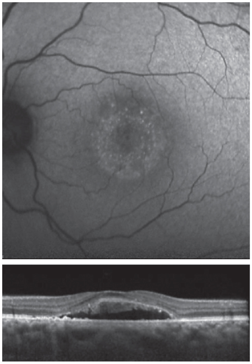 Fig. 7. Fundus autofluorescence (top) and OCT (bottom) are both suggestive of chronic disease.