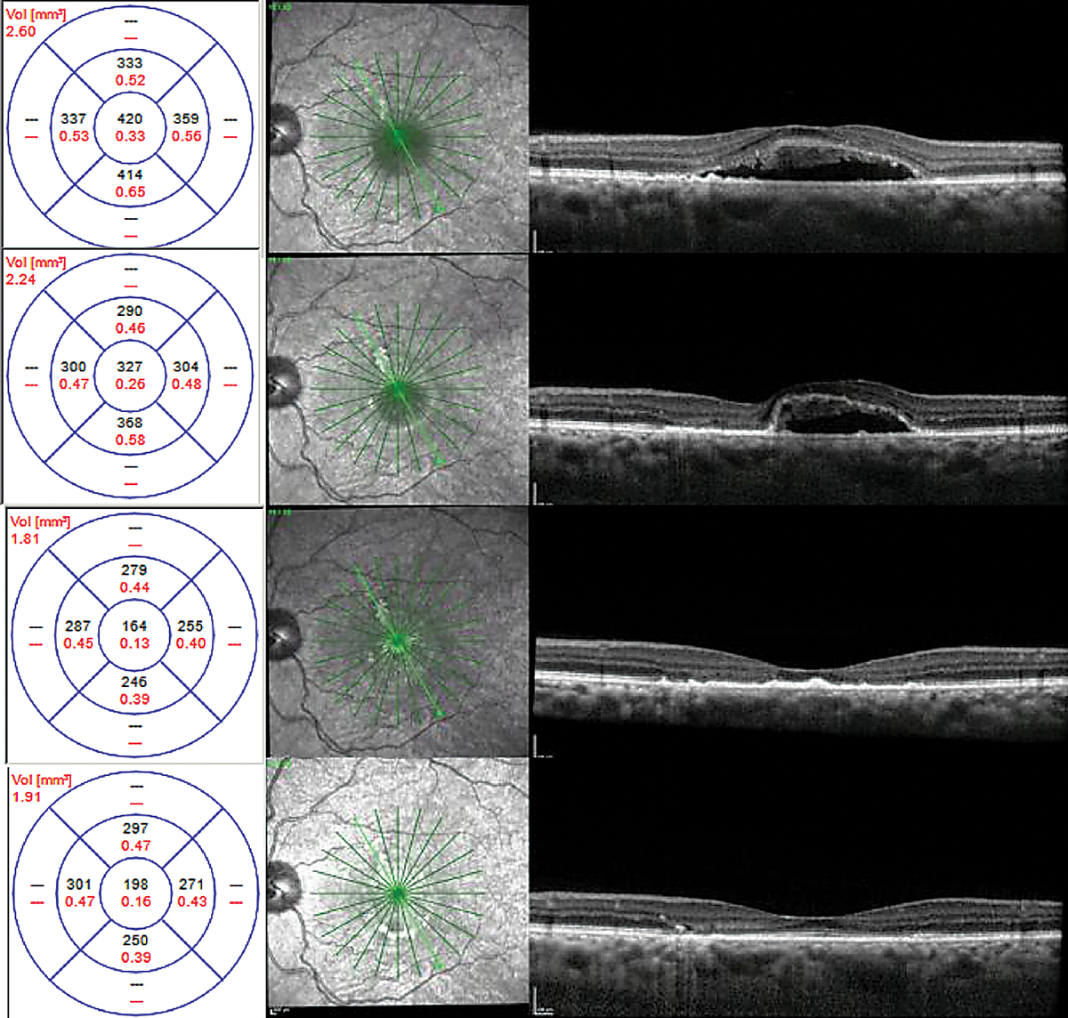 Fig. 9. Chronic CSCR with shaggy photoreceptors at time of laser therapy (top), one month (top middle), two months (bottom middle) and six months (bottom) after focal laser.